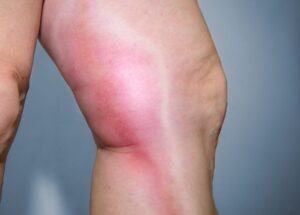 Thrombophlebitis-300x215 Complications of IV Line in Neonates: Risks, Prevention, and Management