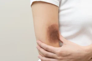 hematoma-300x200 Complications of IV Line in Neonates: Risks, Prevention, and Management
